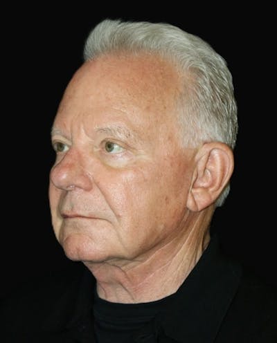 Neck Lift Before & After Gallery - Patient 187484 - Image 1