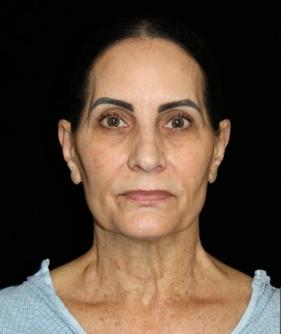 Facelift Before & After Gallery - Patient 356667 - Image 1