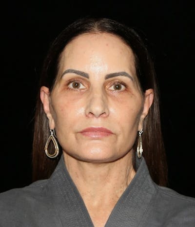 Lip Lift Before & After Gallery - Patient 286124 - Image 1