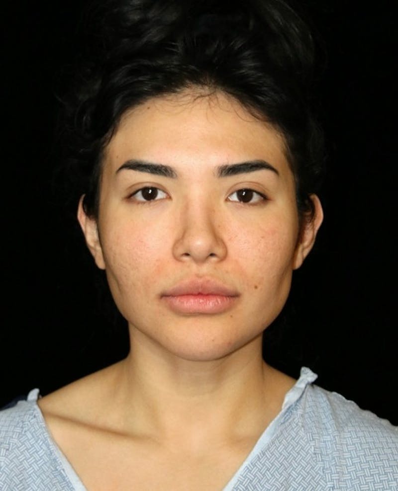 Buccal Fat Restoration Before & After Gallery - Patient 162503 - Image 1