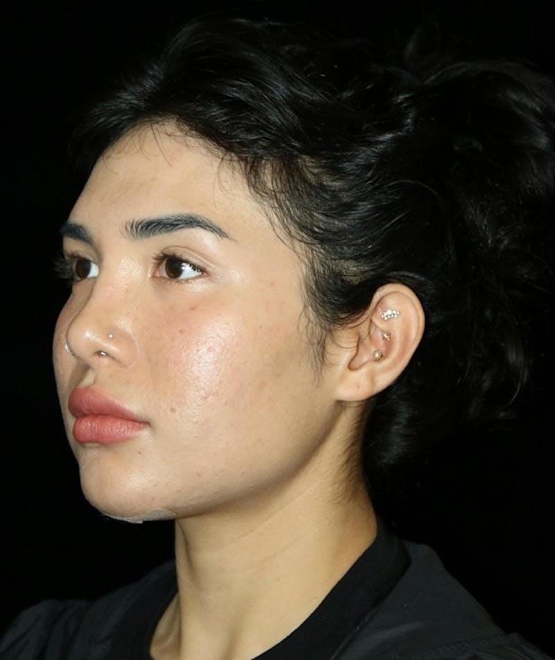 Buccal Fat Restoration Before & After Gallery - Patient 162503 - Image 4
