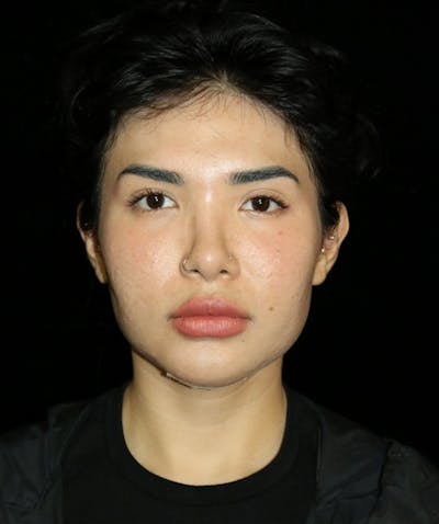 Buccal Fat Restoration Before & After Gallery - Patient 162503 - Image 2