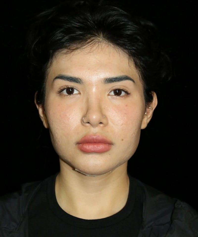 Buccal Fat Restoration Before & After Gallery - Patient 162503 - Image 2