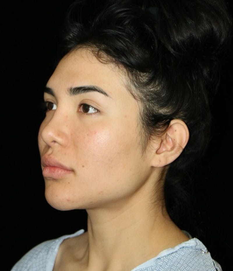 Buccal Fat Restoration Before & After Gallery - Patient 162503 - Image 3