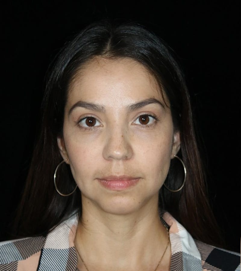 Buccal Fat Restoration Before & After Gallery - Patient 375566 - Image 1