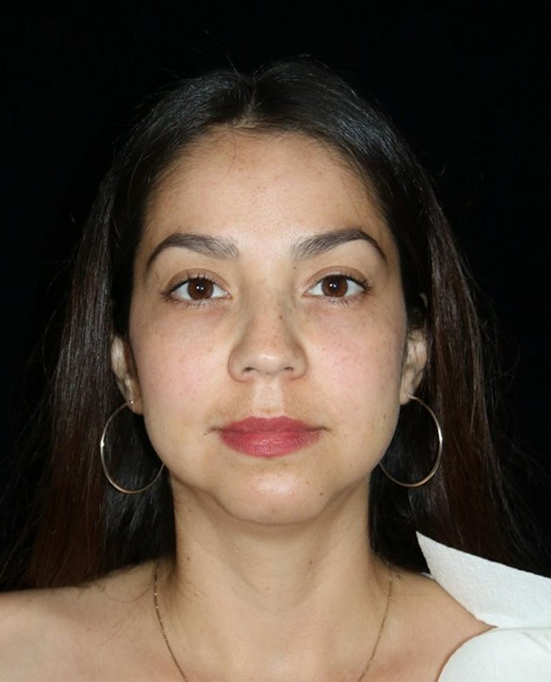 Buccal Fat Restoration Before & After Gallery - Patient 375566 - Image 2