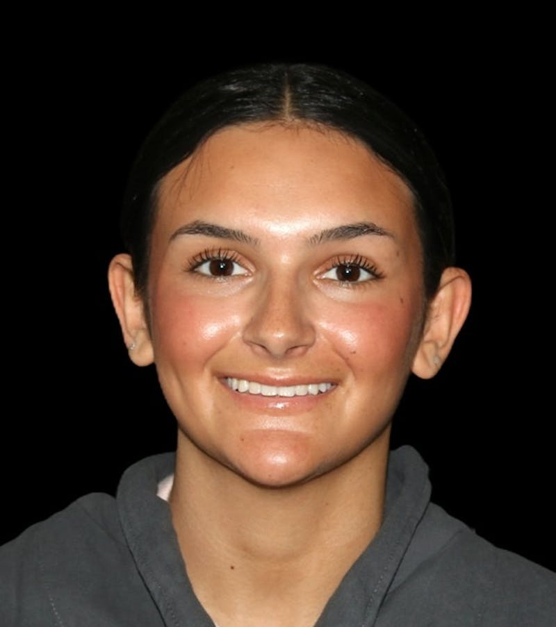 Genioplasty Before & After Gallery - Patient 238786 - Image 1