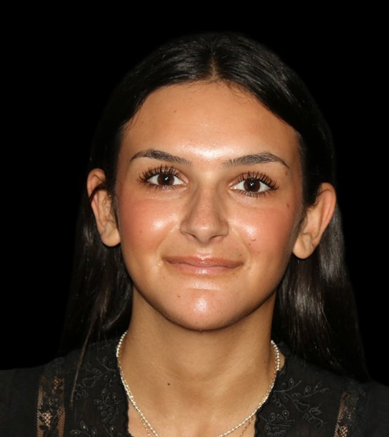 Genioplasty Before & After Gallery - Patient 238786 - Image 2