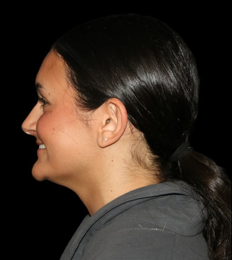 Genioplasty Before & After Gallery - Patient 238786 - Image 7