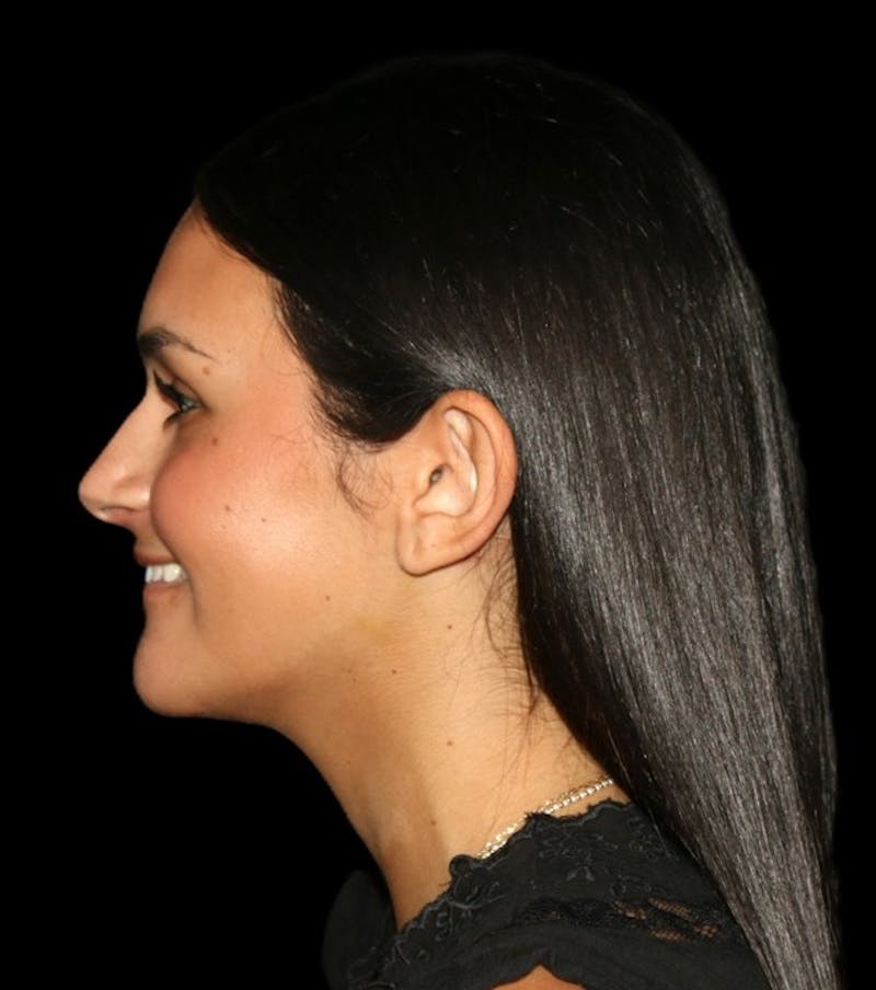 Genioplasty Before & After Gallery - Patient 238786 - Image 8