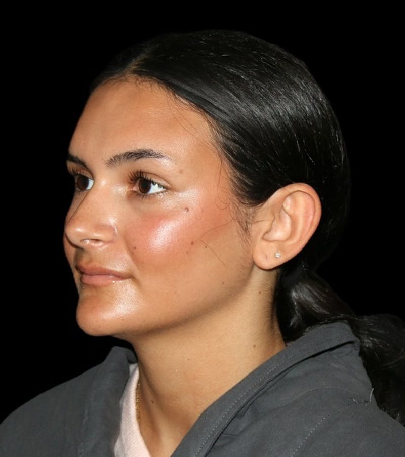 Genioplasty Before & After Gallery - Patient 238786 - Image 5