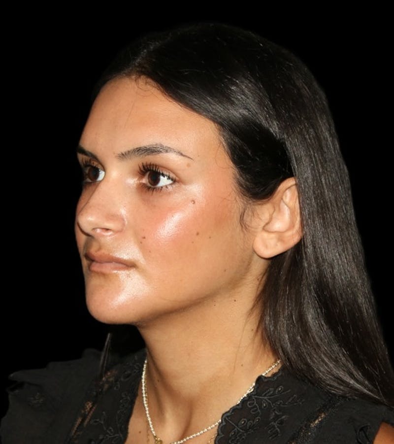 Genioplasty Before & After Gallery - Patient 238786 - Image 6