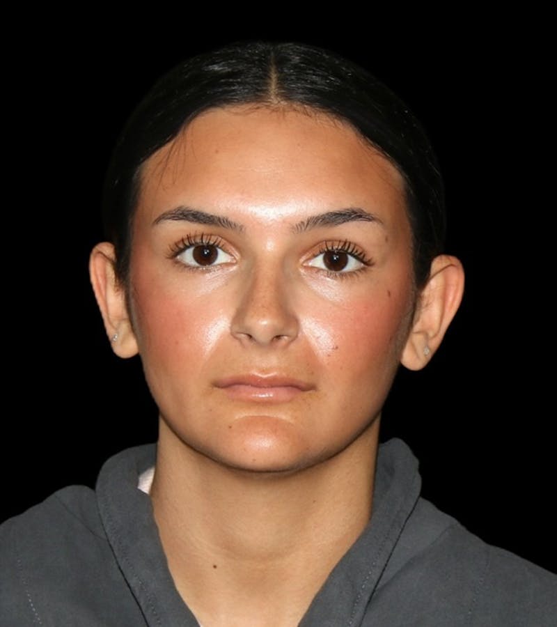 Genioplasty Before & After Gallery - Patient 238786 - Image 3
