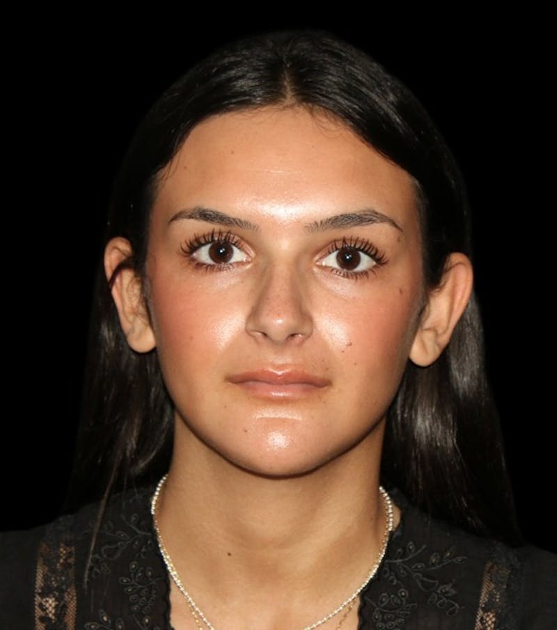 Genioplasty Before & After Gallery - Patient 238786 - Image 4