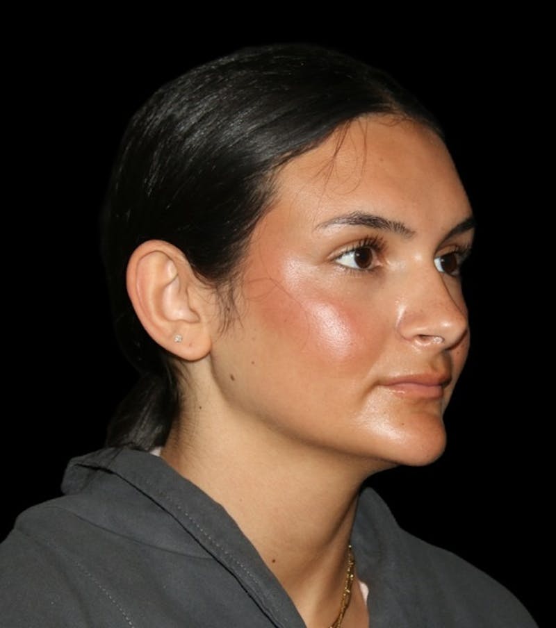 Genioplasty Before & After Gallery - Patient 238786 - Image 11