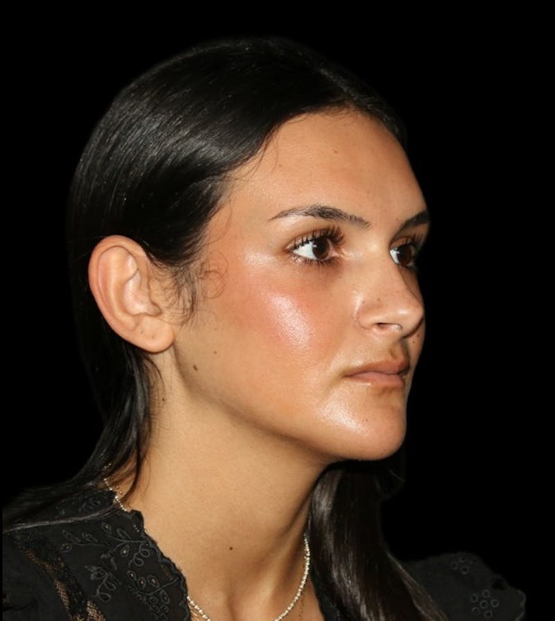 Genioplasty Before & After Gallery - Patient 238786 - Image 12