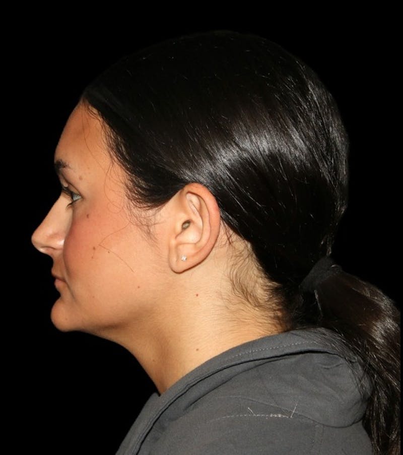 Genioplasty Before & After Gallery - Patient 238786 - Image 9