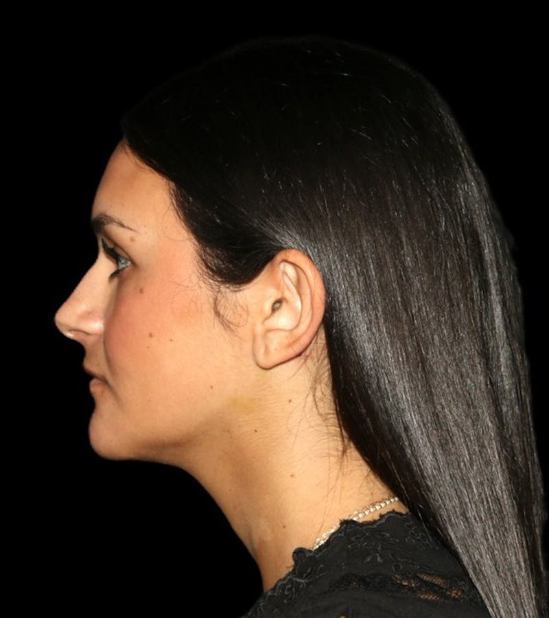 Genioplasty Before & After Gallery - Patient 238786 - Image 10