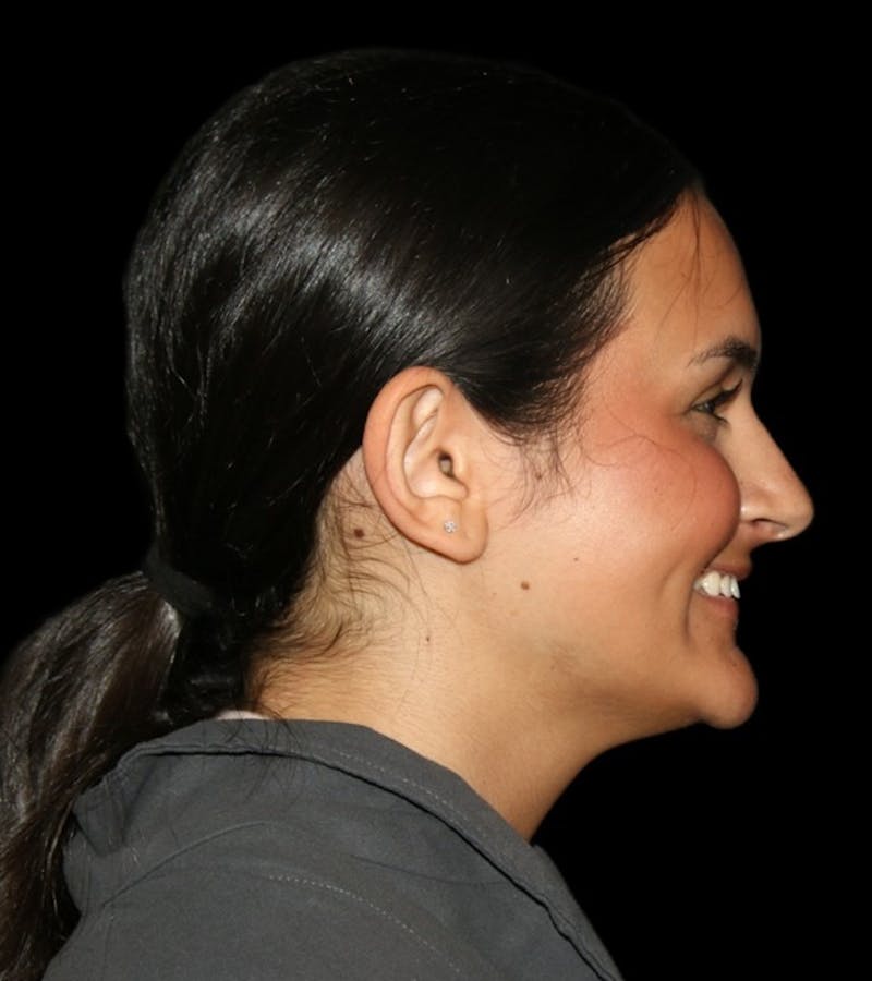 Genioplasty Before & After Gallery - Patient 238786 - Image 13