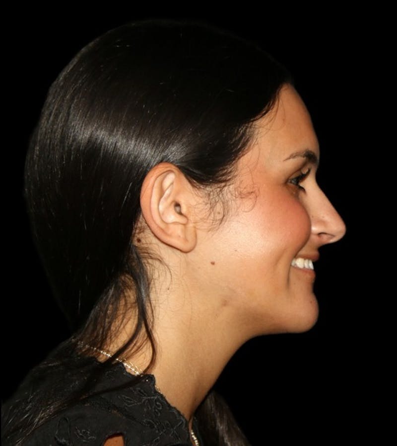Genioplasty Before & After Gallery - Patient 238786 - Image 14