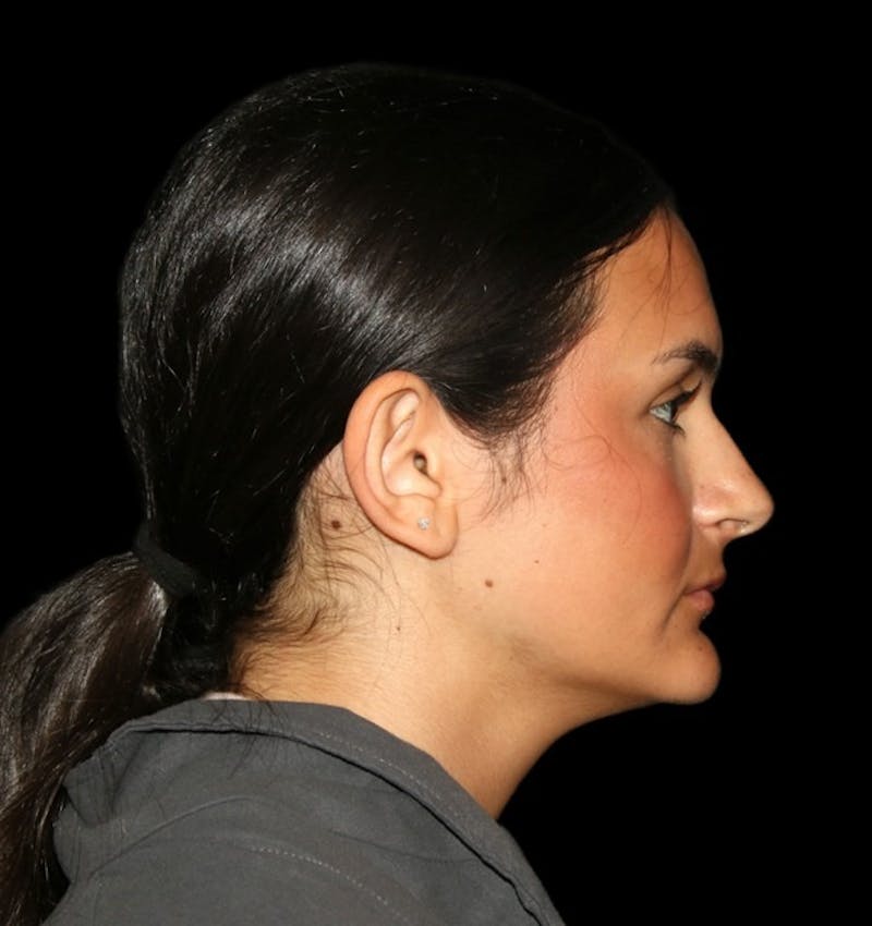 Genioplasty Before & After Gallery - Patient 238786 - Image 15