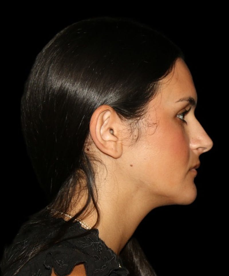 Genioplasty Before & After Gallery - Patient 238786 - Image 16