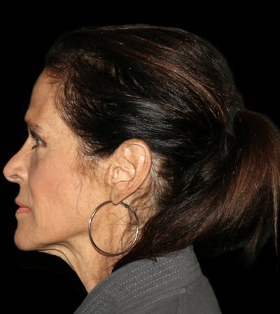 Primary Rhinoplasty Before & After Gallery - Patient 240151 - Image 2