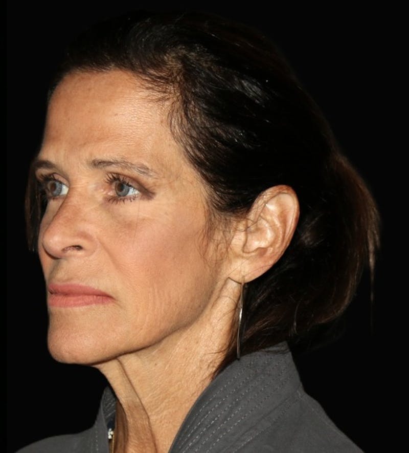 Primary Rhinoplasty Before & After Gallery - Patient 240151 - Image 4