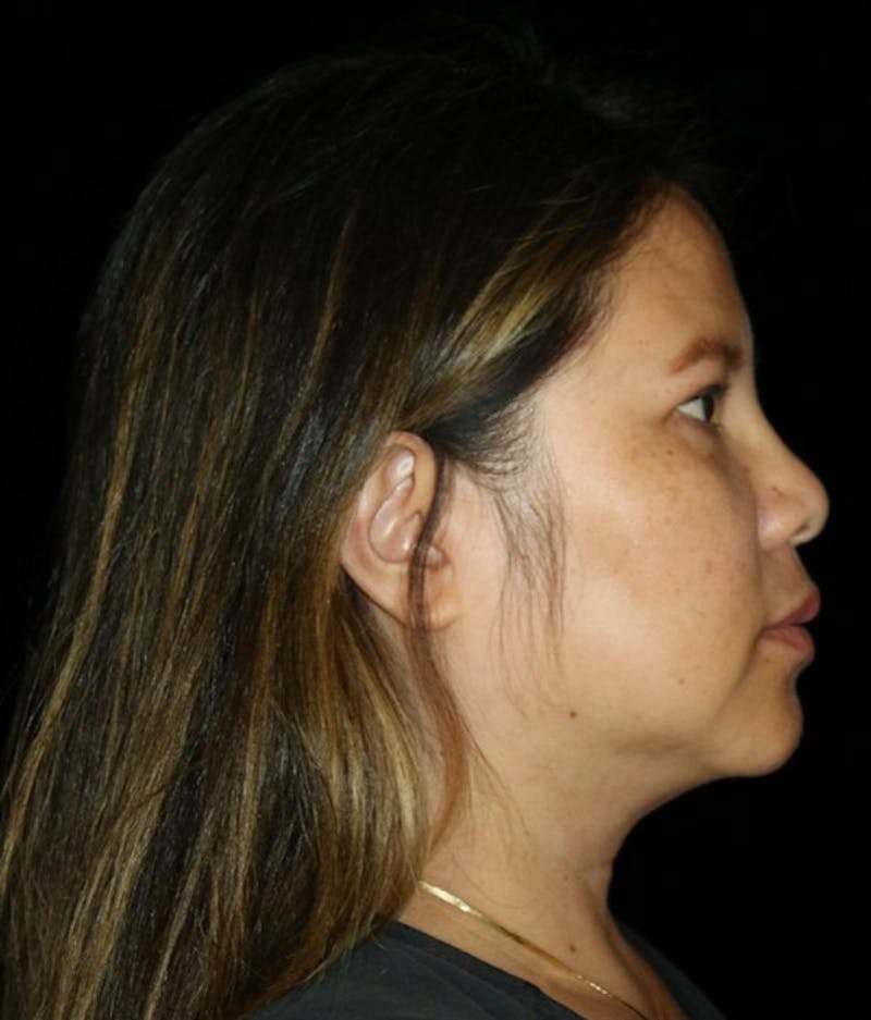 Facelift Before & After Gallery - Patient 408005 - Image 5