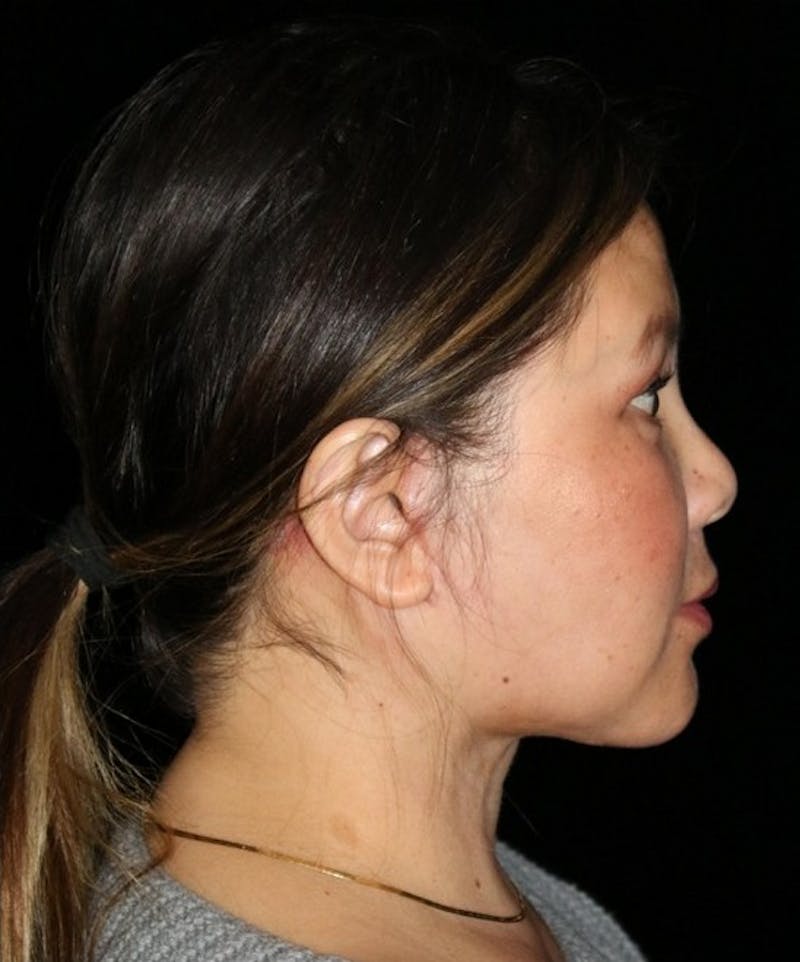 Facelift Before & After Gallery - Patient 408005 - Image 6