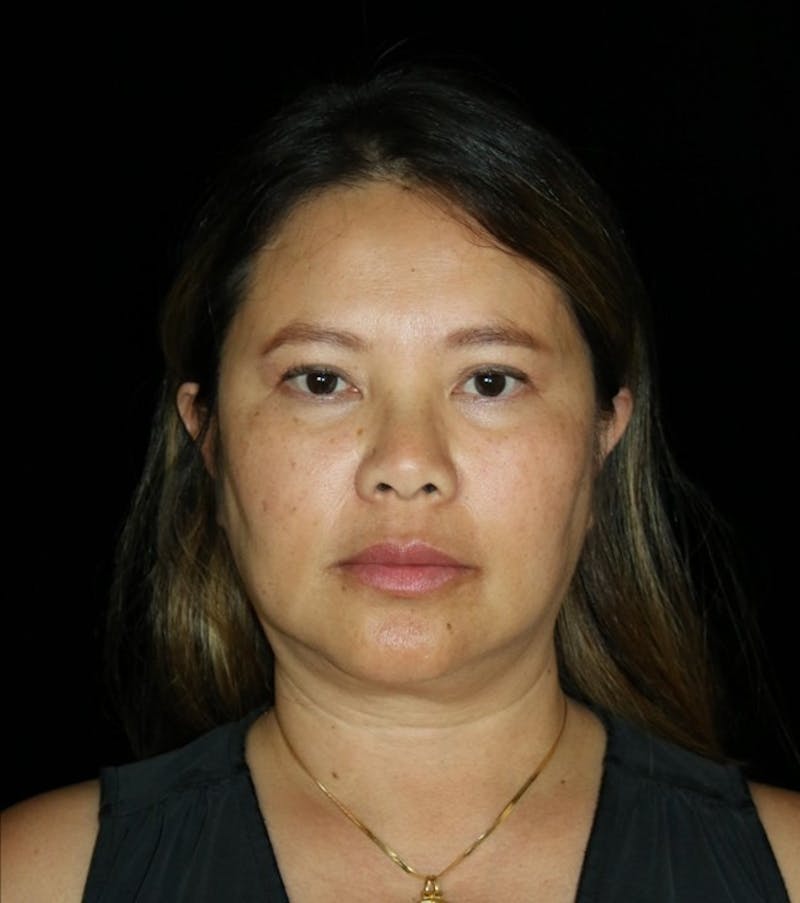 Facelift Before & After Gallery - Patient 408005 - Image 1