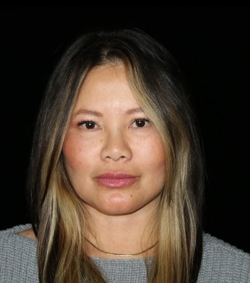 Facelift Before & After Gallery - Patient 408005 - Image 2