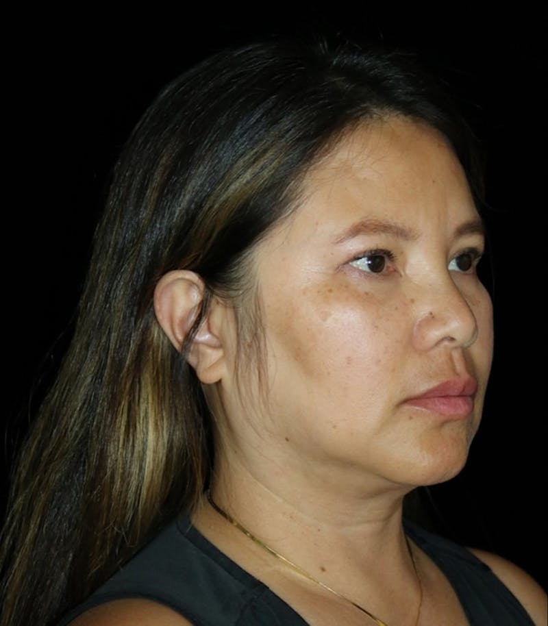 Facelift Before & After Gallery - Patient 408005 - Image 3