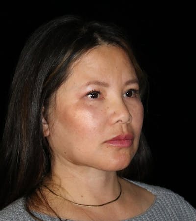 Neck Lift Before & After Gallery - Patient 270920 - Image 2