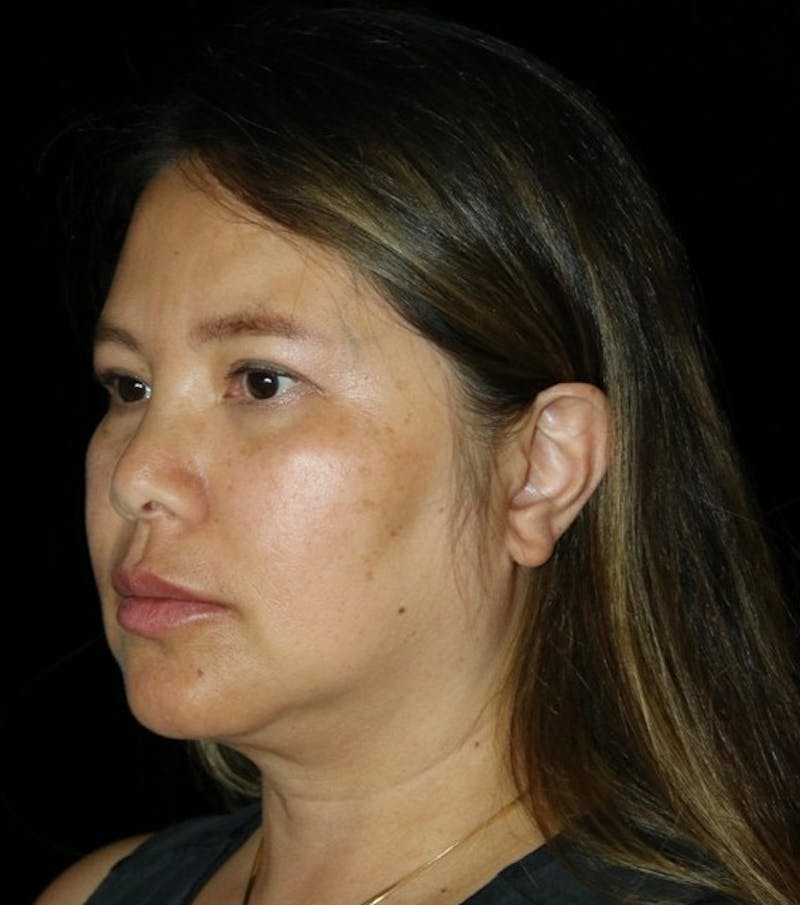 Facelift Before & After Gallery - Patient 408005 - Image 7