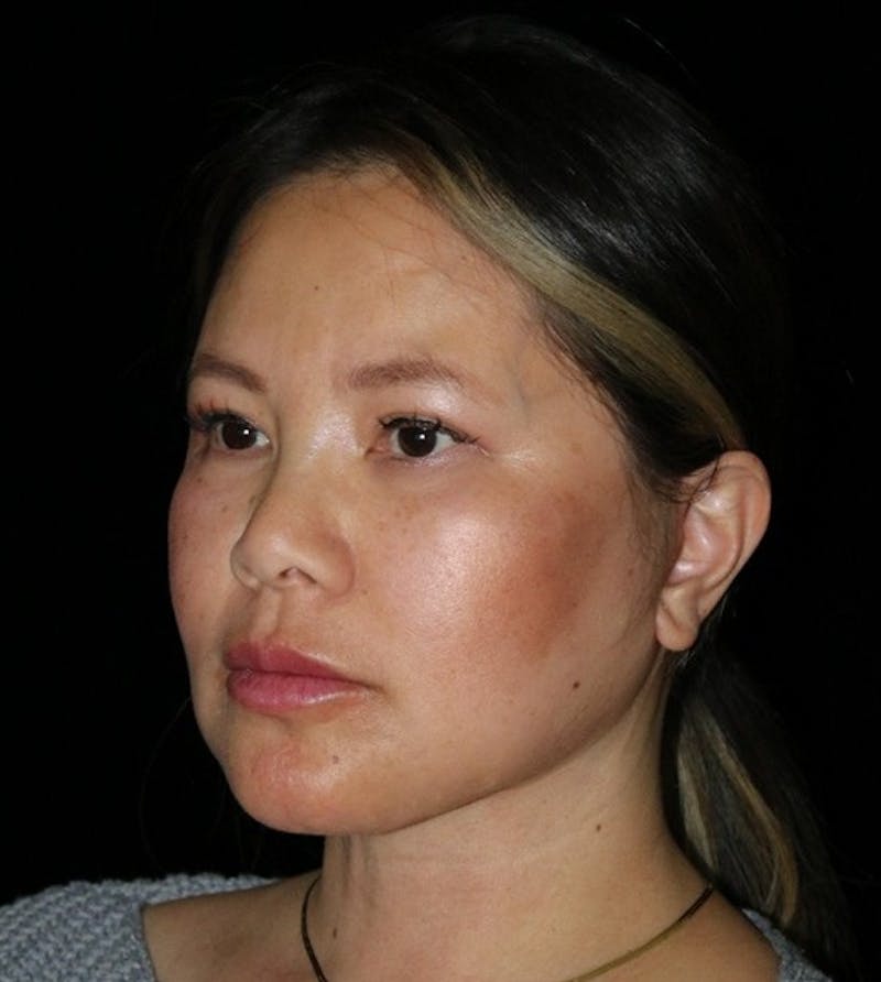Facelift Before & After Gallery - Patient 408005 - Image 8