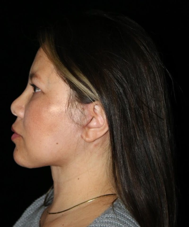 Facelift Before & After Gallery - Patient 408005 - Image 10