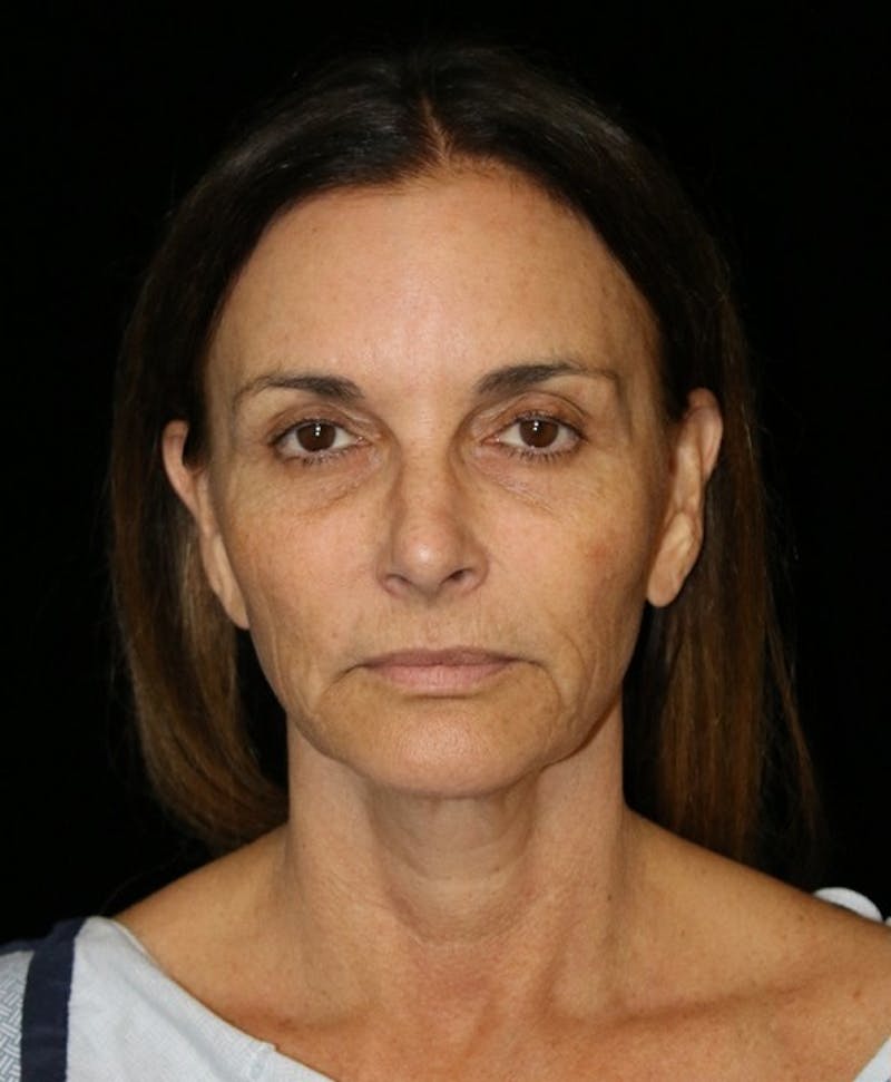 Facelift Before & After Gallery - Patient 948212 - Image 3
