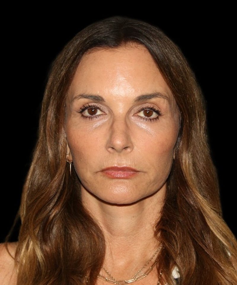 Facelift Before & After Gallery - Patient 948212 - Image 4