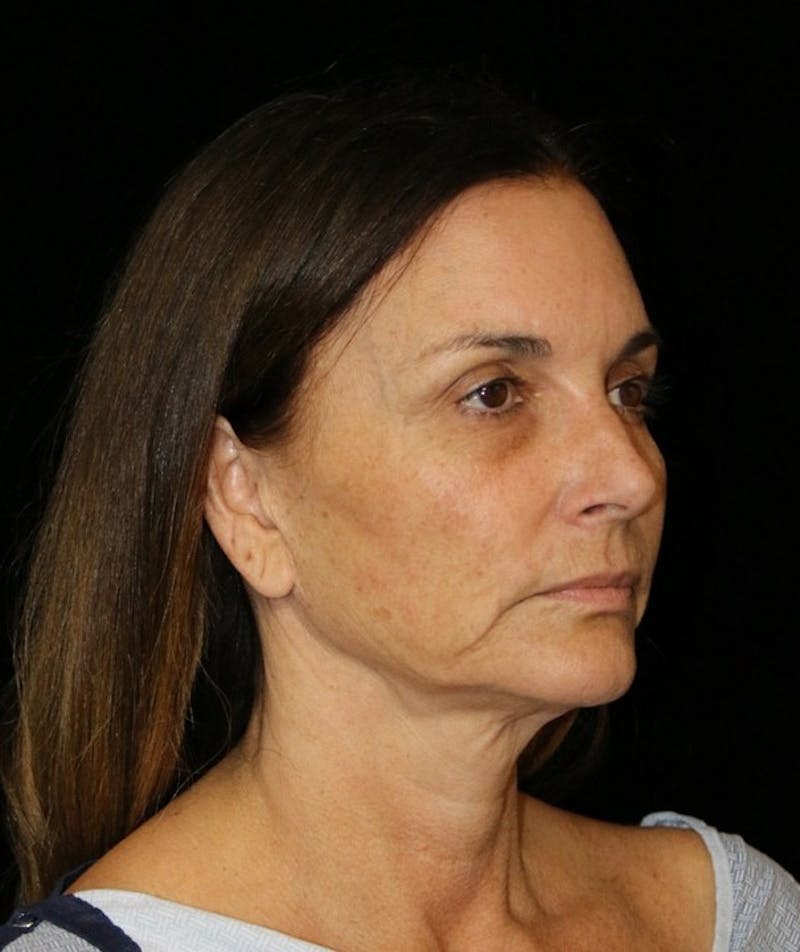 Facelift Before & After Gallery - Patient 948212 - Image 5