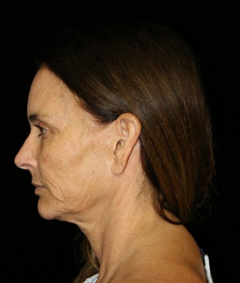 Facelift Before & After Gallery - Patient 948212 - Image 7