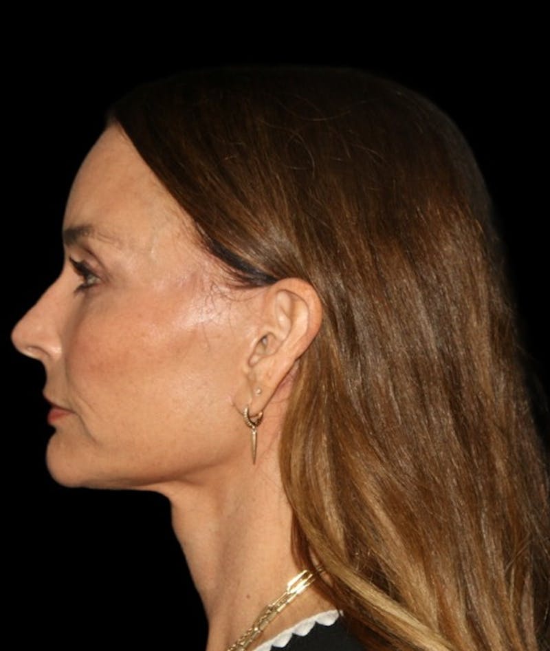 Facelift Before & After Gallery - Patient 948212 - Image 8