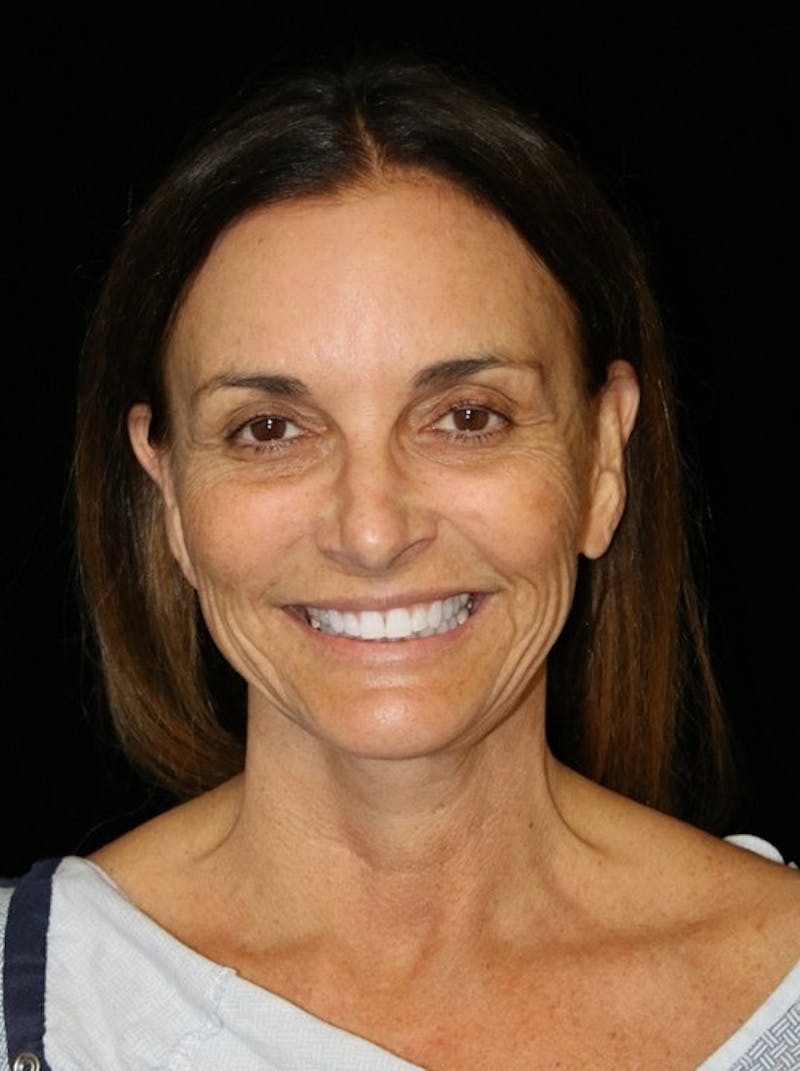 Facelift Before & After Gallery - Patient 948212 - Image 1