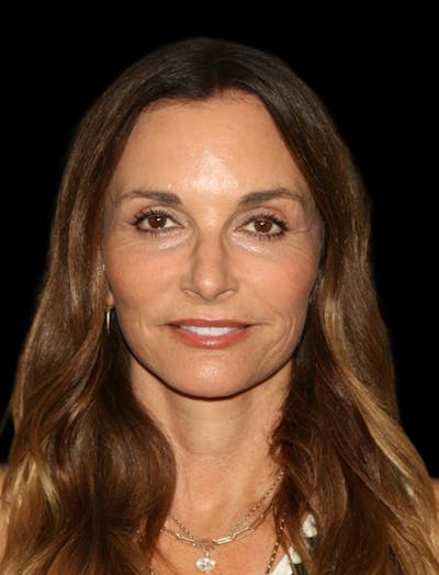 Facelift Before & After Gallery - Patient 948212 - Image 2
