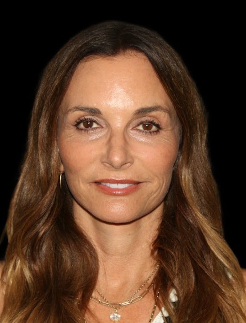 Facelift Before & After Gallery - Patient 948212 - Image 2