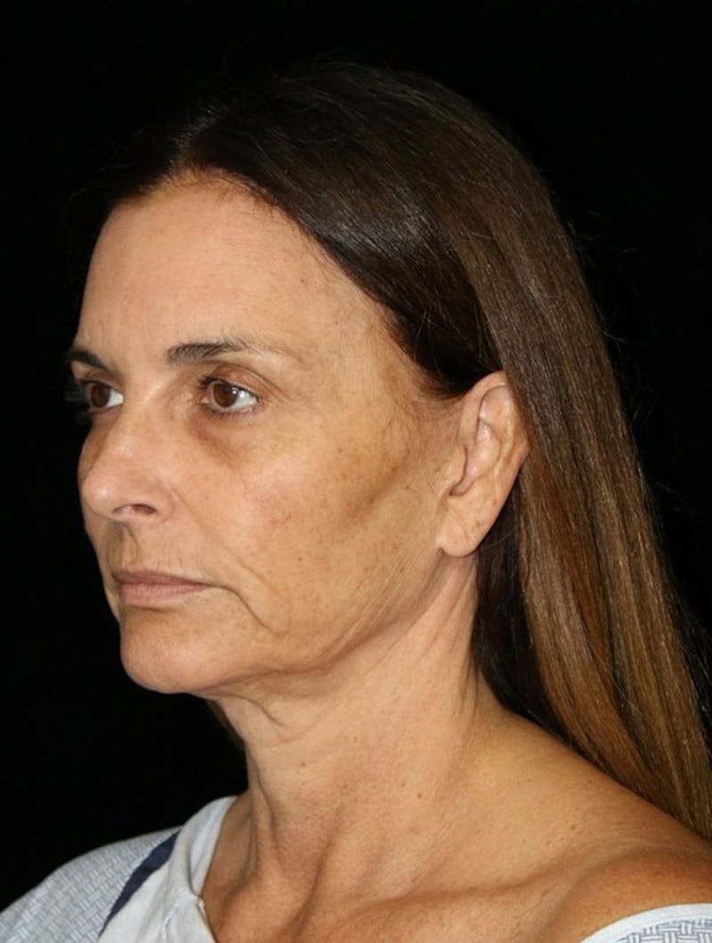 Facelift Before & After Gallery - Patient 948212 - Image 9