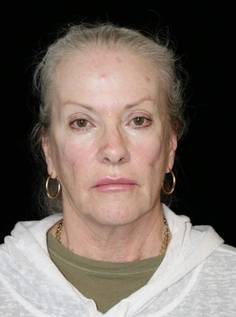 Facelift Before & After Gallery - Patient 707484 - Image 1