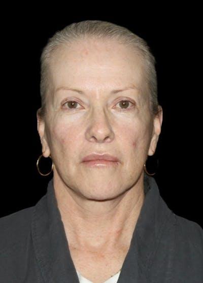 Facelift Before & After Gallery - Patient 707484 - Image 2