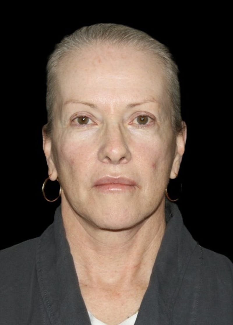 Facelift Before & After Gallery - Patient 707484 - Image 2