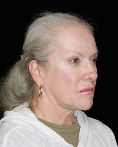 Neck Lift Before & After Gallery - Patient 926688 - Image 1